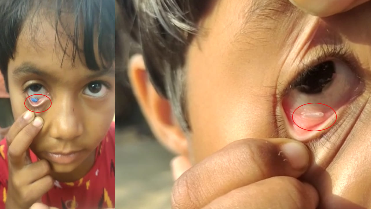 Telangana: ఎన్నడూ చూడని వింత.. పాప కంటి నుంచి ఉబికి వస్తున్న బియ్యం, ప్లాస్టిక్ కవర్లు, వ్యర్థాలు