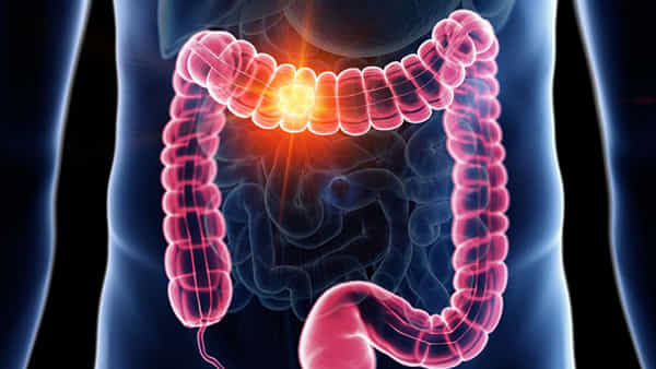 Bowel Cancer: పెద్దప్రేగు క్యాన్సర్ వస్తే ఎలాంటి లక్షణాలు ఉంటాయి..?