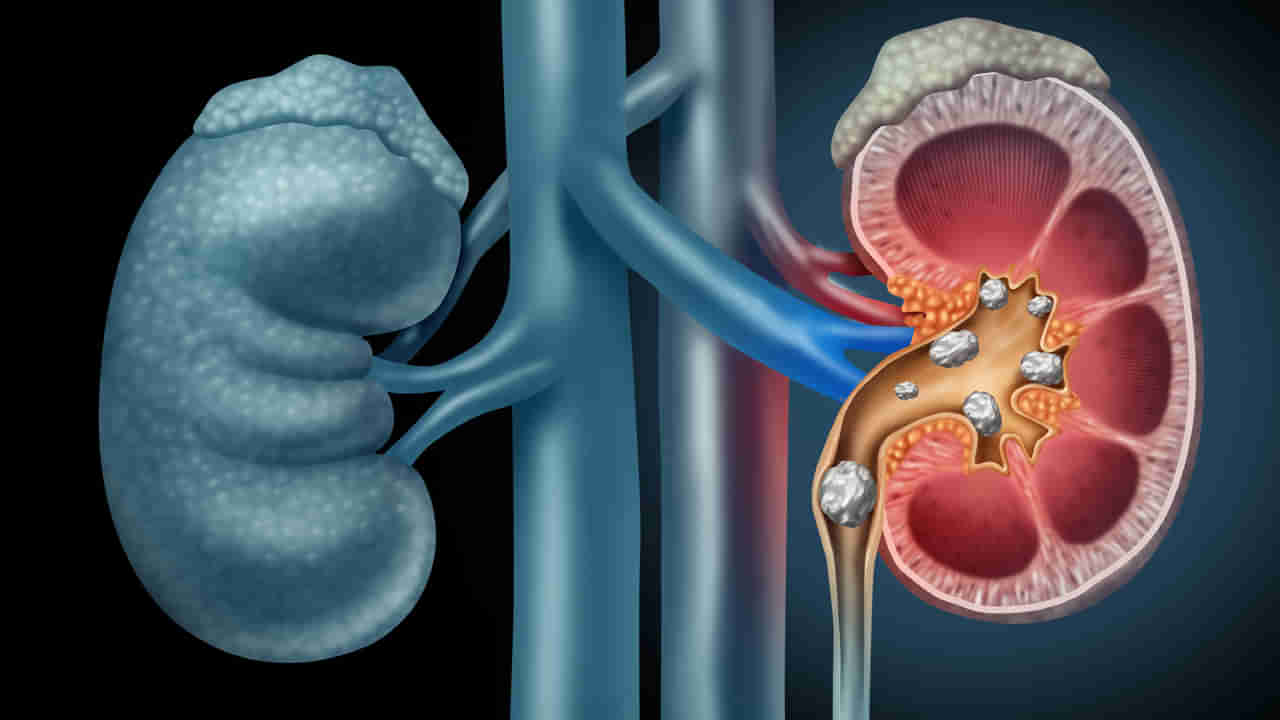 Kidney Stones: మీ కిడ్నీల్లో రాళ్ల సమస్యలున్నాయా..? ఇలా చేస్తే అద్భుతమైన ఫలితాలు..!