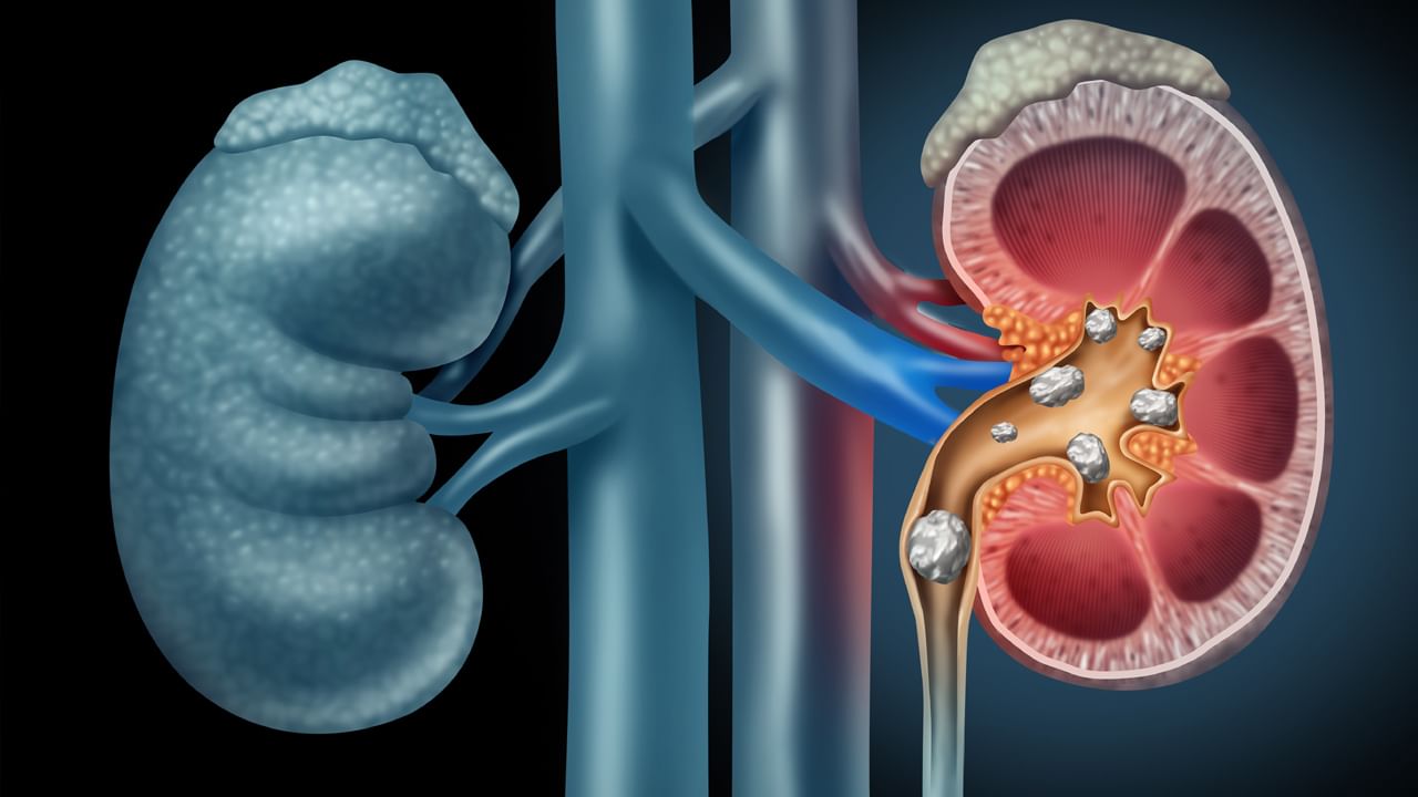 Kidney Stones: మీ కిడ్నీల్లో రాళ్ల సమస్యలున్నాయా..? ఇలా చేస్తే అద్భుతమైన ఫలితాలు..!