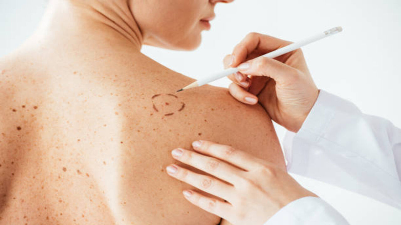 Skin cancer: చర్మ క్యాన్సర్ ను ఎలా గుర్తించాలి... ఎలాంటి జాగ్రత్తలు తీసుకోవాలి..