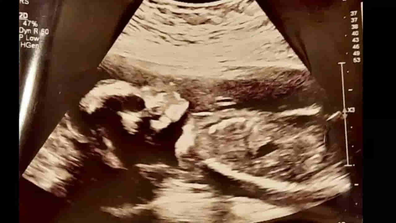 Viral: అల్ట్రాసౌండ్ స్కానింగ్లో పుట్టబోయే బిడ్డను చూడాలనుకుంది.. కట్ చేస్తే.. దెబ్బకు మైండ్ బ్లాంక్!