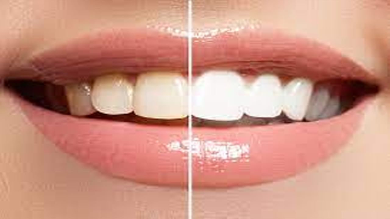 White Teeth Tips: మీ పళ్లు తెల్లగా మిలమిల మెరవాలంటే.. ఈ సింపుల్ చిట్కాలు ఫాలో అవ్వండి.