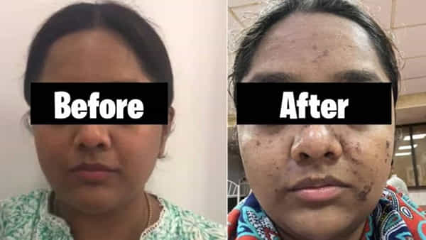 Viral: రూ.17,500 పెట్టి సెలూన్లో ఫేషియల్ చేయించిన మహిళ.. ఆ తర్వాత