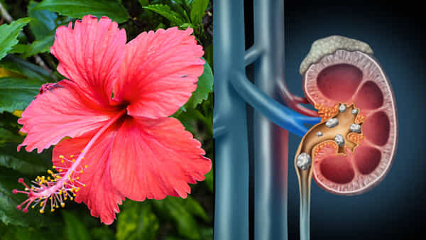 Kidney Stone: మందార పువ్వు కిడ్నీలలోని రాళ్లను ఐస్లా కరిగిస్తుంది...ఎలాగో తెలుసా?