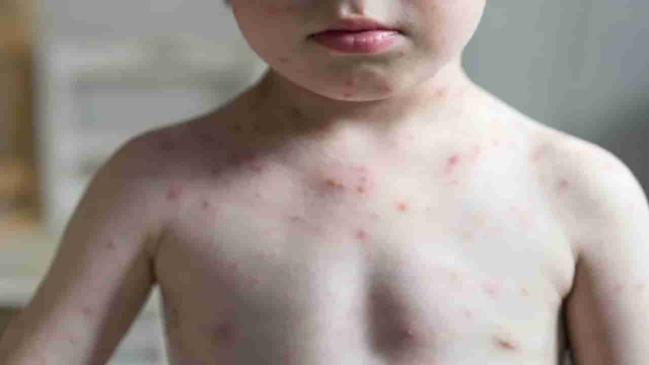 Kids Skin Problems: మీ పిల్లలు తామర సమస్యతో బాధపడుతున్నారా? కారణం అదే అంటున్న నిపుణులు.. అదేంటో తెలుసుకోండి