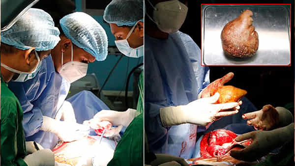 Largest Kidney Stone: బాబోయ్ కిడ్నీలో రాయి కాదు! ఏకంగా పె..ద్ద.. బండ! గిన్నిస్ రికార్డుకెక్కిన కిడ్నీ స్టోన్