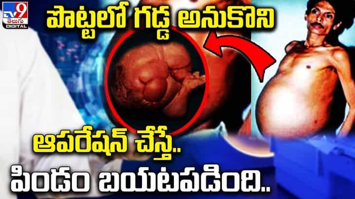 పొట్టలో గడ్డ అనుకొని ఆపరేషన్ చేస్తే.. పిండం బయటపడింది పొట్టలో గడ్డ అనుకొని ఆపరేషన్ చేస్తే.. పిండం బయటపడింది