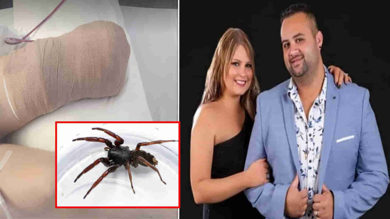 Spider Bite: కుట్టింది సాలీడు కదా అనుకుంది.. చివరికి కాలు పోగొట్టుకుని వికలాంగురాలైన మహిళ..