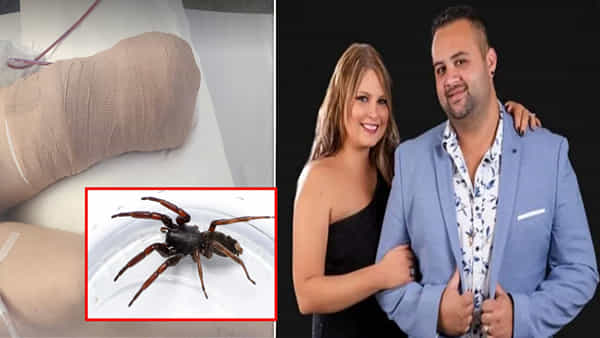 Spider Bite: కుట్టింది సాలీడు కదా అనుకుంది.. చివరికి కాలు పోగొట్టుకుని వికలాంగురాలైన మహిళ..