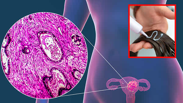 Uterine Cancer: ఆ క్రీమ్లతో గర్భాశయ క్యాన్సర్..? తాజా అధ్యయనంలో విస్తుపోయే వివరాలు..