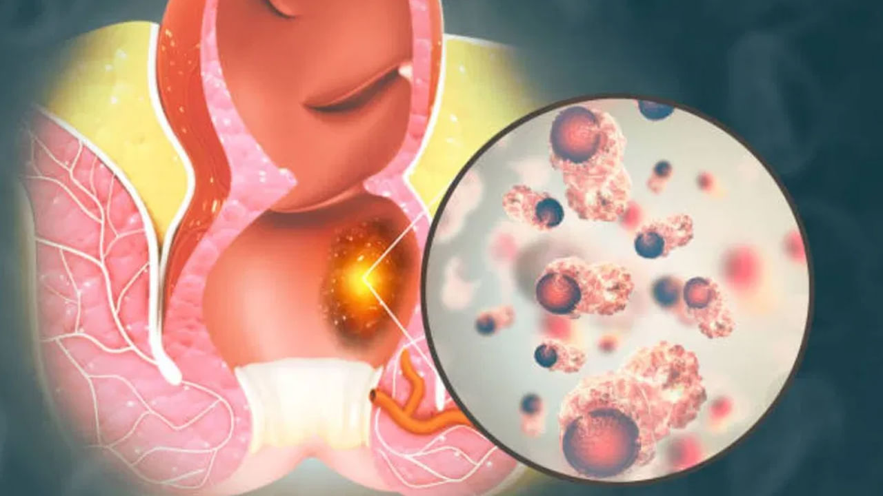 మలబద్ధకం అనేక కారణాలను కలిగి ఉంటుంది. సరిగ్గా నిద్రపోకపోతే, తక్కువ నీరు తాగడం వల్ల ఈ సమస్య వస్తుంది. మళ్ళీ, అదే సమస్య చాలా ఆయిల్, స్పైసీ ఫుడ్ తినడం వల్ల తలెత్తుతుంది. విపరీతమైన శారీరక శ్రమ ఉంటే, వ్యాయామం ఎక్కువగా చేసినా ఈ సమస్య రావచ్చు.