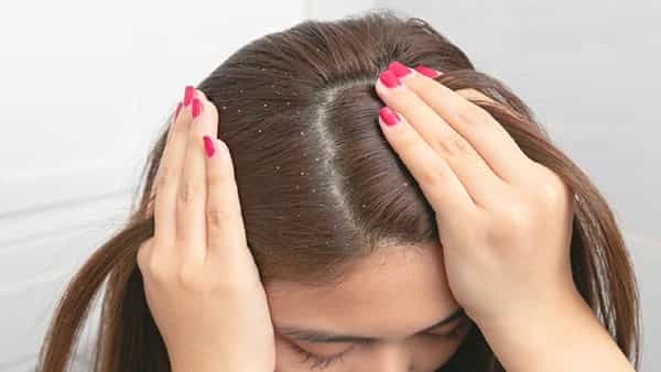 Dandruff Tips: చుండ్రు సమస్యతో జుట్టు ఊడిపోతుందా? ఈ టిప్స్తో సమస్యకు చెక్..