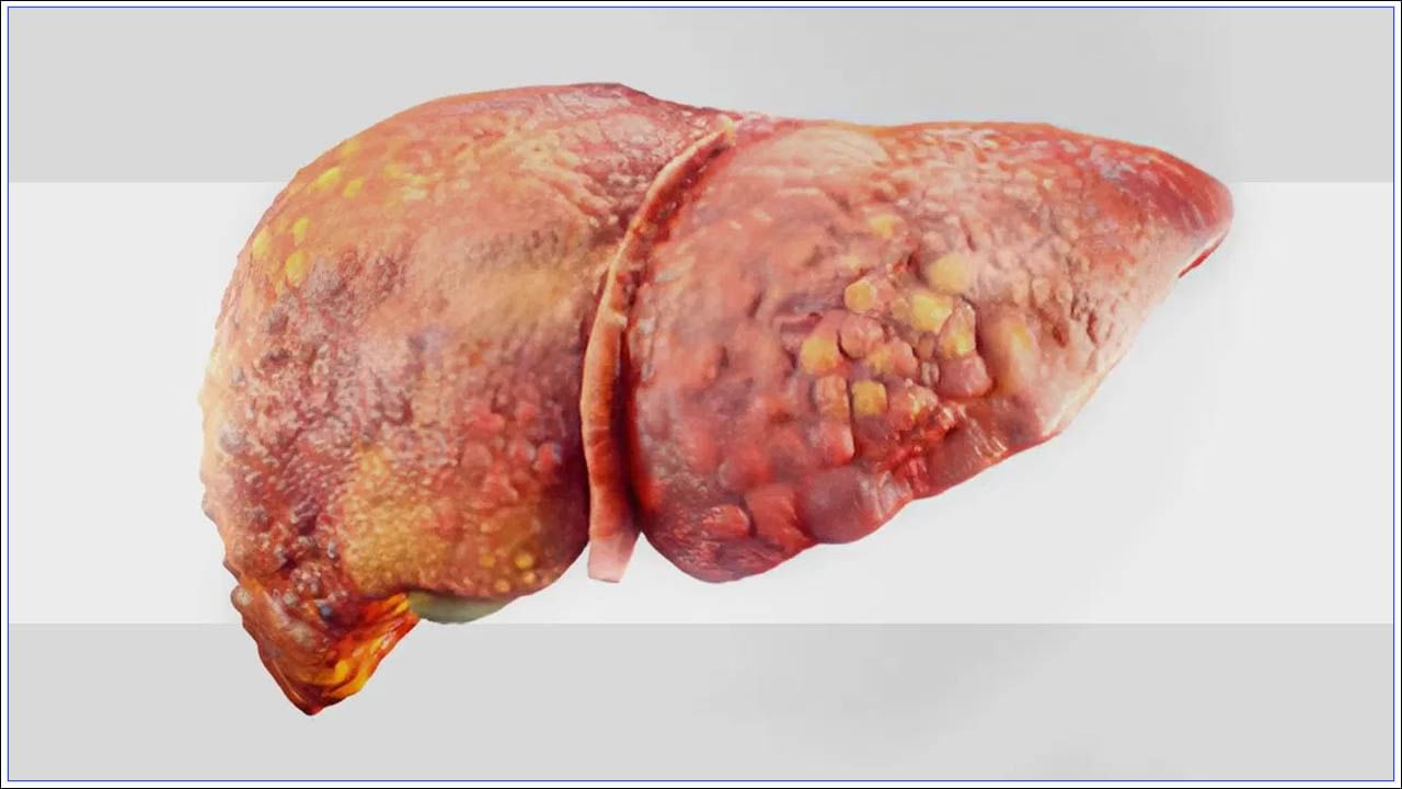 Fatty Liver: మద్యం తాగనివారు కూడా ఫ్యాటీ లివర్ బాధితులుగా ఎందుకు మారుతున్నారు?