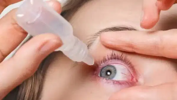 Health Tips: పెరుగుతున్న కండ్లకలక కేసులు.. ఈ జాగ్రత్తలు తీసుకోకుంటే ప్రమాదమే!!