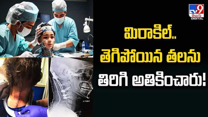 మిరాకిల్.. తెగిపోయిన తలను తిరిగి అతికించారు మిరాకిల్.. తెగిపోయిన తలను తిరిగి అతికించారు