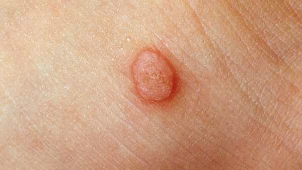 Health Tips: పులిపిర్లతో ఇబ్బంది పడుతున్నారా ? ఇంట్లో లభించే వాటితో నేచురల్ గా తొలగించుకోండి