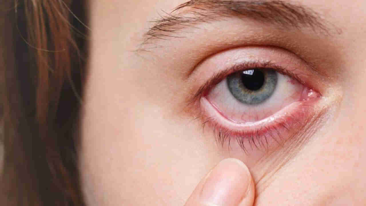 Conjunctivitis: కండ్లకలక వచ్చిన వారి కళ్ళల్లోకి చూస్తే మనకూ వస్తాయా ? అసలు నిజం ఇదే