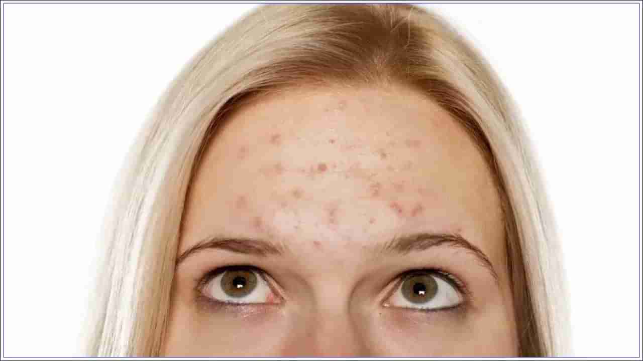 Pimples: నుదుటిపై మొటిమలతో బాధపడుతున్నారా..? ఇలా చేస్తే అదిరిపోయే లుక్ మీ సొంతం