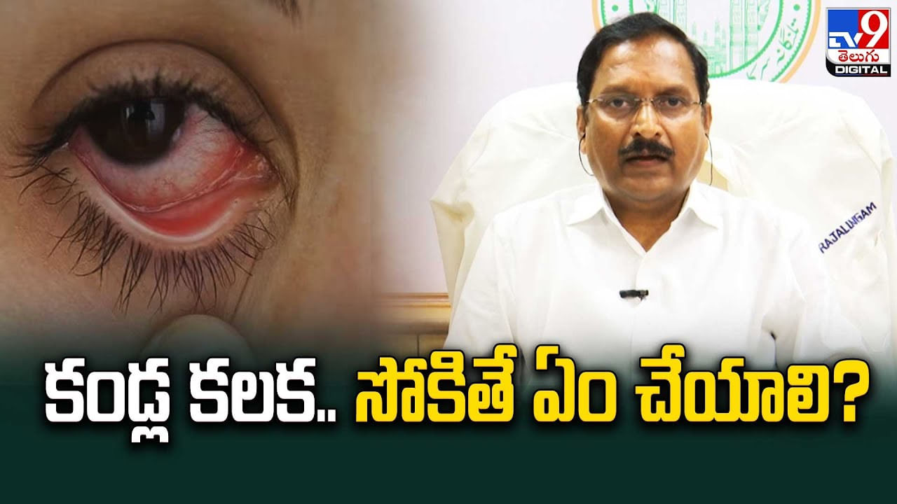 Conjunctivitis: కండ్లకలక వస్తే తీసుకోవాల్సిన జాగ్రత్తలు.. వేగంగా వ్యాపిస్తున్న కండ్ల కలక..