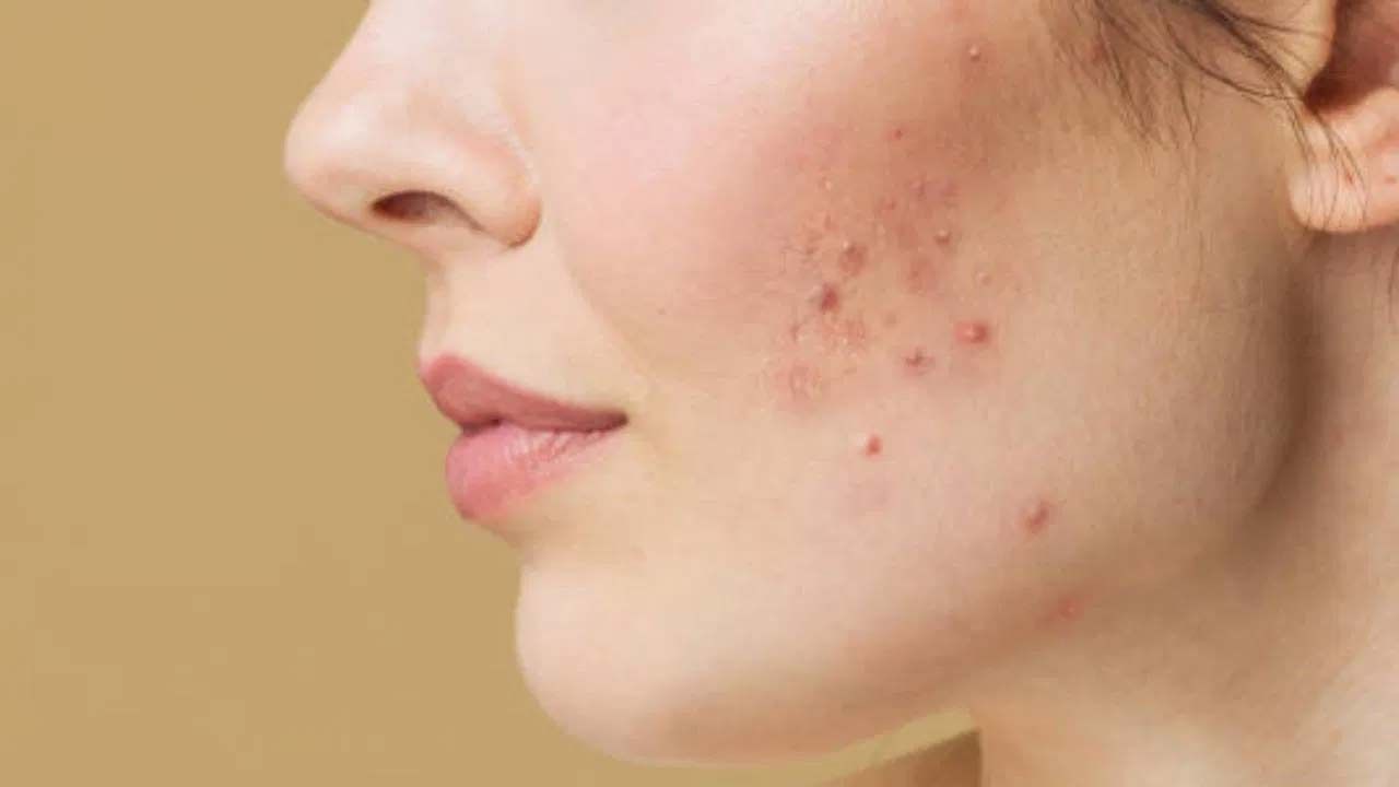 ముఖంపై మచ్చల నివారణకు పసుపు, గంధం పేస్ట్ ఉపయోగించవచ్చు. ములేటి పొడి, పసుపు, రోజ్ వాటర్‌తో చేసిన ఫేస్‌పామ్‌ని ఉపయోగించవచ్చు. అలాగే బంగాళాదుంప రసాన్ని ముఖానికి రాసుకోవచ్చు. 