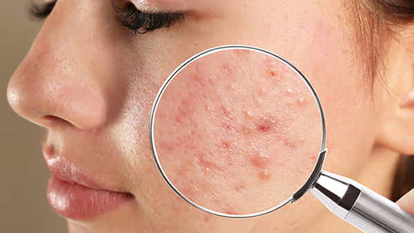 Skincare: ముఖంపై బ్లైండ్ పింపుల్స్ ఉన్నాయా..? ఎలాంటి ఖర్చు లేకుండానే సమస్యకు చెక్ పెట్టేయండిలా..