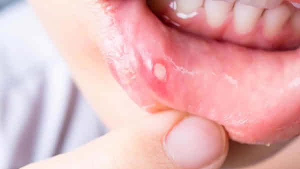 Home Remedies To Soothe Canker Sores: అధిక వేడివల్ల నోటిపూత, నోటిలో పొక్కులతో ఇబ్బందిగా ఉందా? ఈ చిట్కాలు ఫాలో అవ్వండి!!