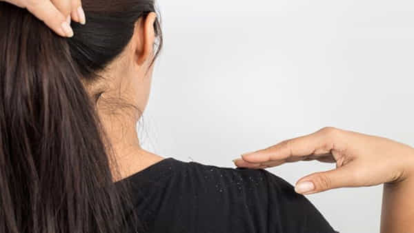 Dandruff : చుండ్రు సమస్యతో బాధపడుతున్నారా..? ఈ సింపుల్ హోం రెమిడీస్ ట్రై చేయండి..ఒత్తైన జుట్టు మీ సొంతం..