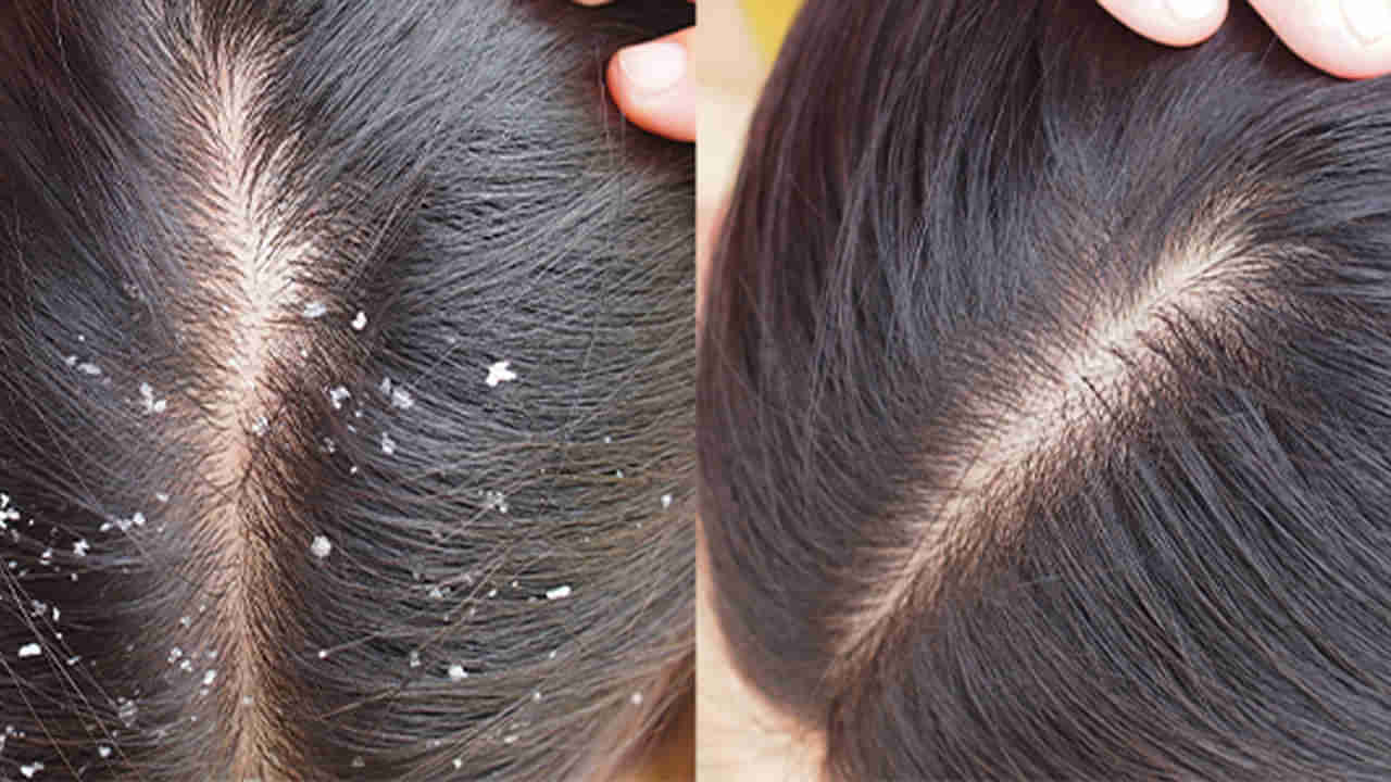 Hair Care: ఎన్ని షాంపూలు వాడినా చుండ్రు వదలట్లేదా..? ఈ హోమ్ రెమెడీస్‌ని ట్రై చేసి చూడండి.. మెరిసే జుట్టు కూడా మీ సొంతమవుతుంది..