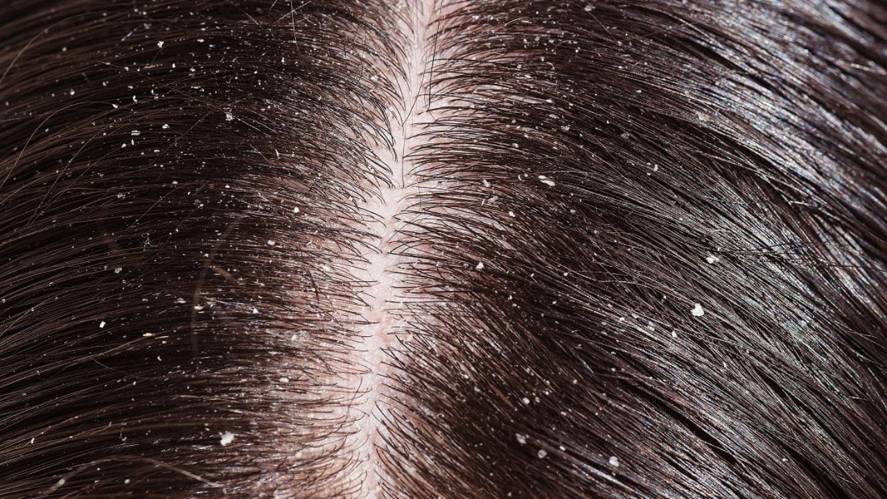 Dandruff Tips: దీంతో చుండ్రు సమస్యనే కాదు.. జుట్టు కూడా పెరుగుతుంది!