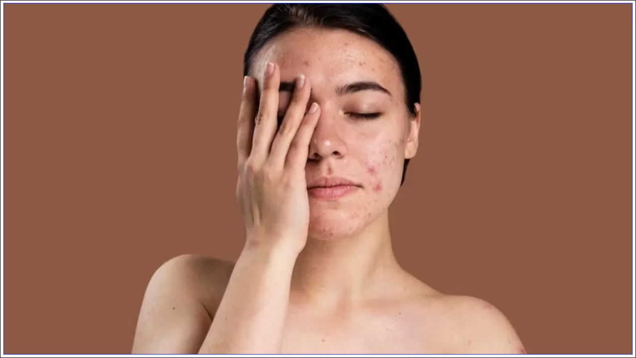 Face Pimples: మీ ముఖంపై మొటిమలు మళ్లీ మళ్లీ వస్తున్నాయా..? ఈ చిట్కాలు పాటించండి