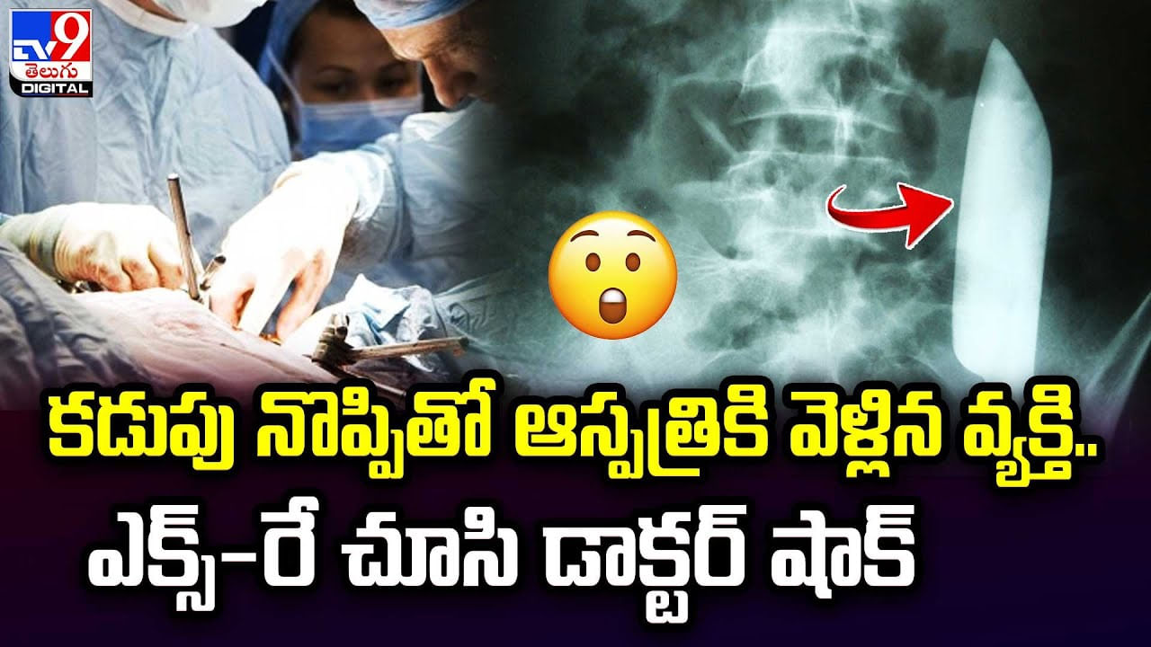 Knife in Stomach: కడుపు నొప్పితో ఆస్పత్రికి వెళ్లిన వ్యక్తి.. ఎక్స్‌-రే చూసి డాక్టర్‌ షాక్‌..!