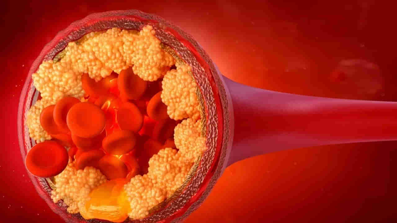 LDL Cholestrol: బ్యాడ్ కొలెస్ట్రాల్ స్థాయి ఎల్లప్పుడూ 100 mg/dL కంటే ఎక్కువగా ఉంటుందా.. ఇలా తగ్గించుకోండి..