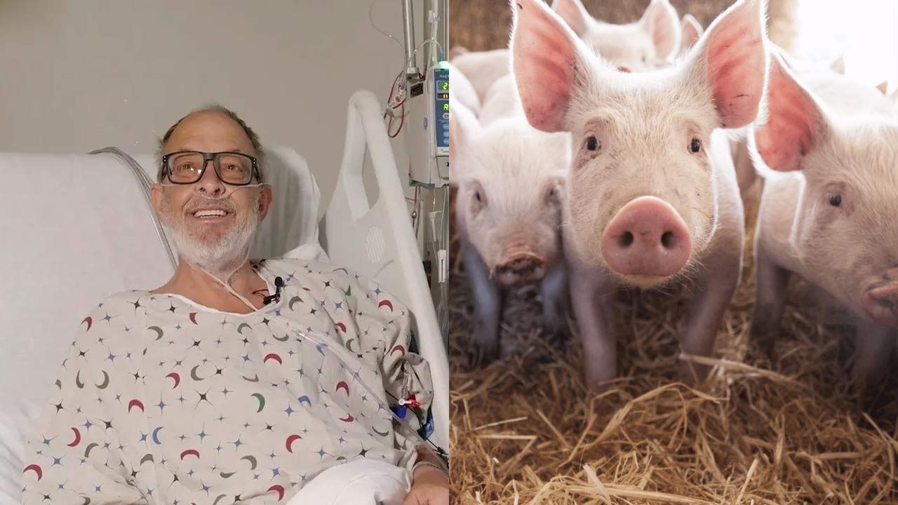 Pig Heart Transplantation మనిషికి పంది గుండె అమర్చిన వైద్యులు.. రెండు