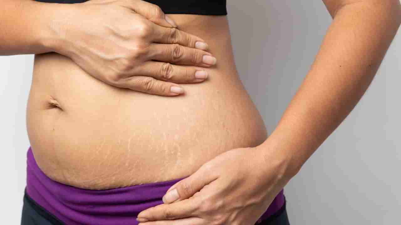 Stretch Marks: స్ట్రెచ్ మార్క్స్ తో ఇబ్బంది పడుతున్నారా.. అయితే ఈ సింపుల్ టిప్స్ ఫాలో అవ్వండి!!