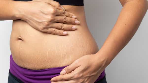 Stretch Marks: స్ట్రెచ్ మార్క్స్ తో ఇబ్బంది పడుతున్నారా.. అయితే ఈ సింపుల్ టిప్స్ ఫాలో అవ్వండి!!