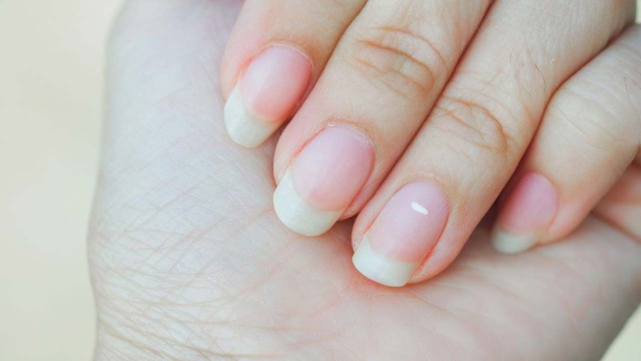White Spots on Nails: మీ గోళ్లపై కూడా ఇలా తెల్ల మచ్చలు ఉన్నాయా? జాగ్రత్త ఈ వ్యాధులకు సంకేతం