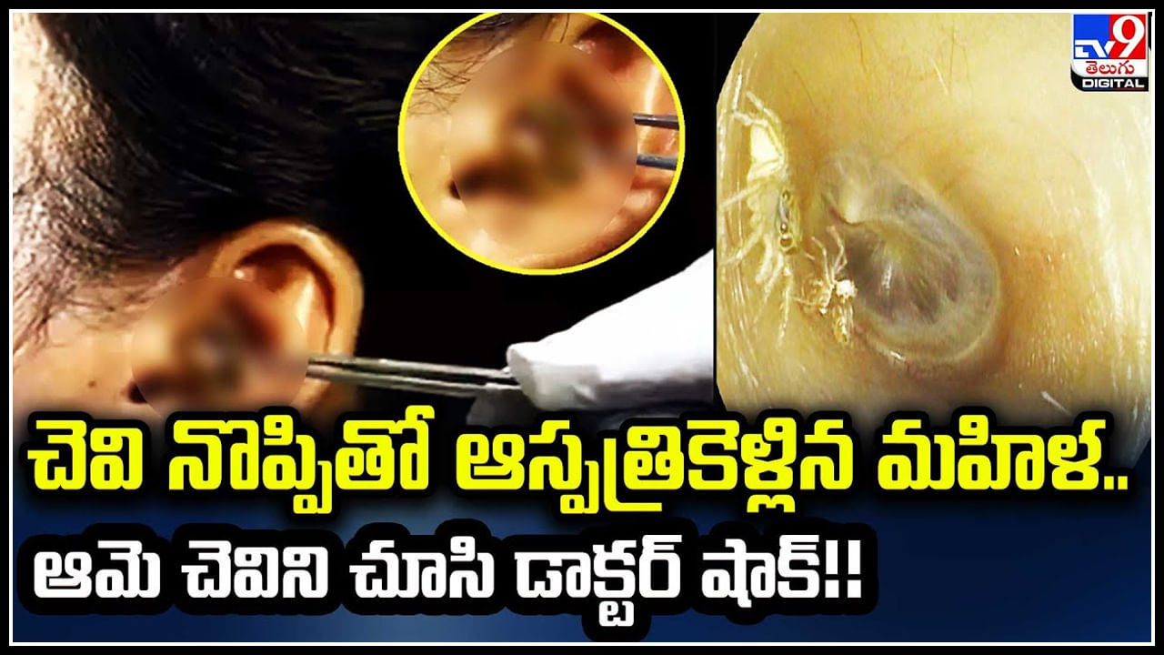 Spider in Ear: చెవి నొప్పితో ఆస్పత్రికెళ్లిన మహిళ.. ఆమె చెవిని చూసి డాక్టర్ షాక్.! వీడియో వైరల్