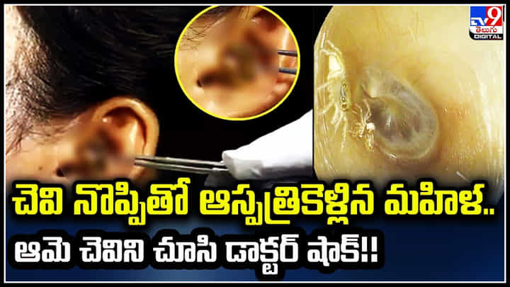 Spider in Ear: చెవి నొప్పితో ఆస్పత్రికెళ్లిన మహిళ.. ఆమె చెవిని చూసి డాక్టర్ షాక్.! వీడియో వైరల్ Spider in Ear: చెవి నొప్పితో ఆస్పత్రికెళ్లిన మహిళ.. ఆమె చెవిని చూసి డాక్టర్ షాక్.! వీడియో వైరల్