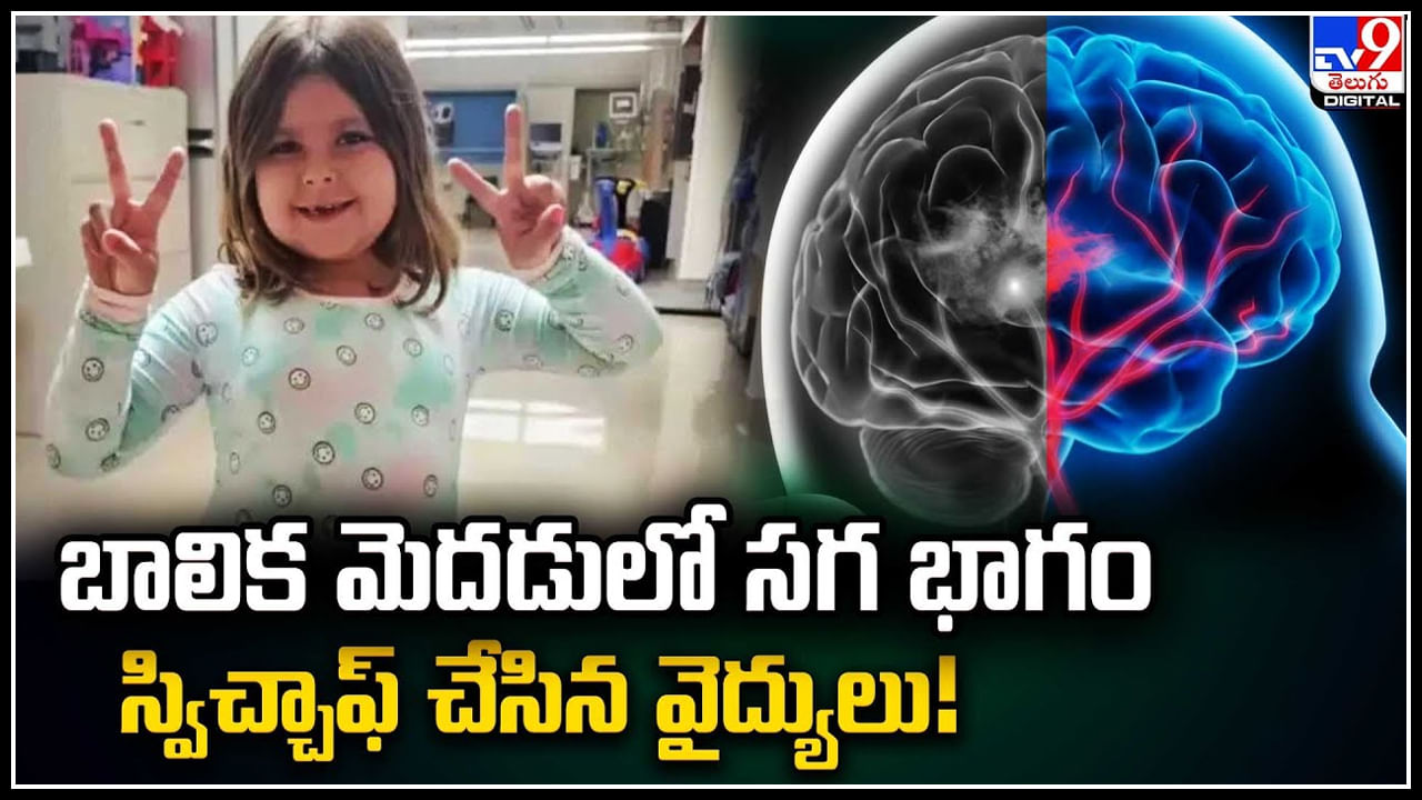 Viral: బాలిక మెదడులో సగ భాగం స్విచ్చాఫ్ చేసిన వైద్యులు..!  ఎందుకంటే..?