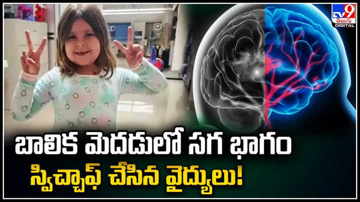 Viral: బాలిక మెదడులో సగ భాగం స్విచ్చాఫ్ చేసిన వైద్యులు..! ఎందుకంటే..? Viral: బాలిక మెదడులో సగ భాగం స్విచ్చాఫ్ చేసిన వైద్యులు..! ఎందుకంటే..?