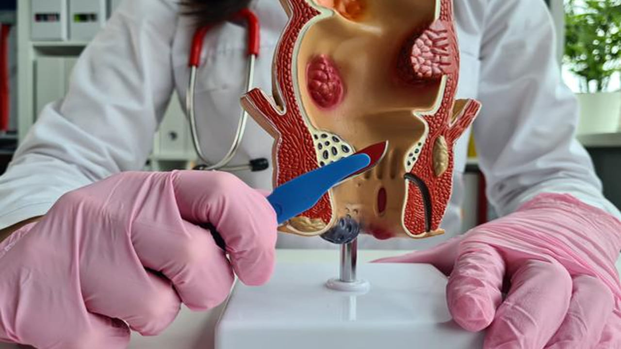 అయినప్పటికీ దీర్ఘకాలిక మలబద్ధకం, దీర్ఘకాలిక విరేచనాలు, ప్రేగు కదలికల సమయంలో టాయిలెట్లో ఎక్కువసేపు కూర్చోవడం వంటి అంశాలు పైల్స్ వలన వచ్చే ప్రమాదాన్ని పెంచుతాయి. అలాగే తక్కువ ఫైబర్ తీసుకోవడం, వ్యాధులు, కుటుంబ చరిత్ర ఈ సమస్య మరింత ప్రమాదాన్ని పెంచుతుంది.