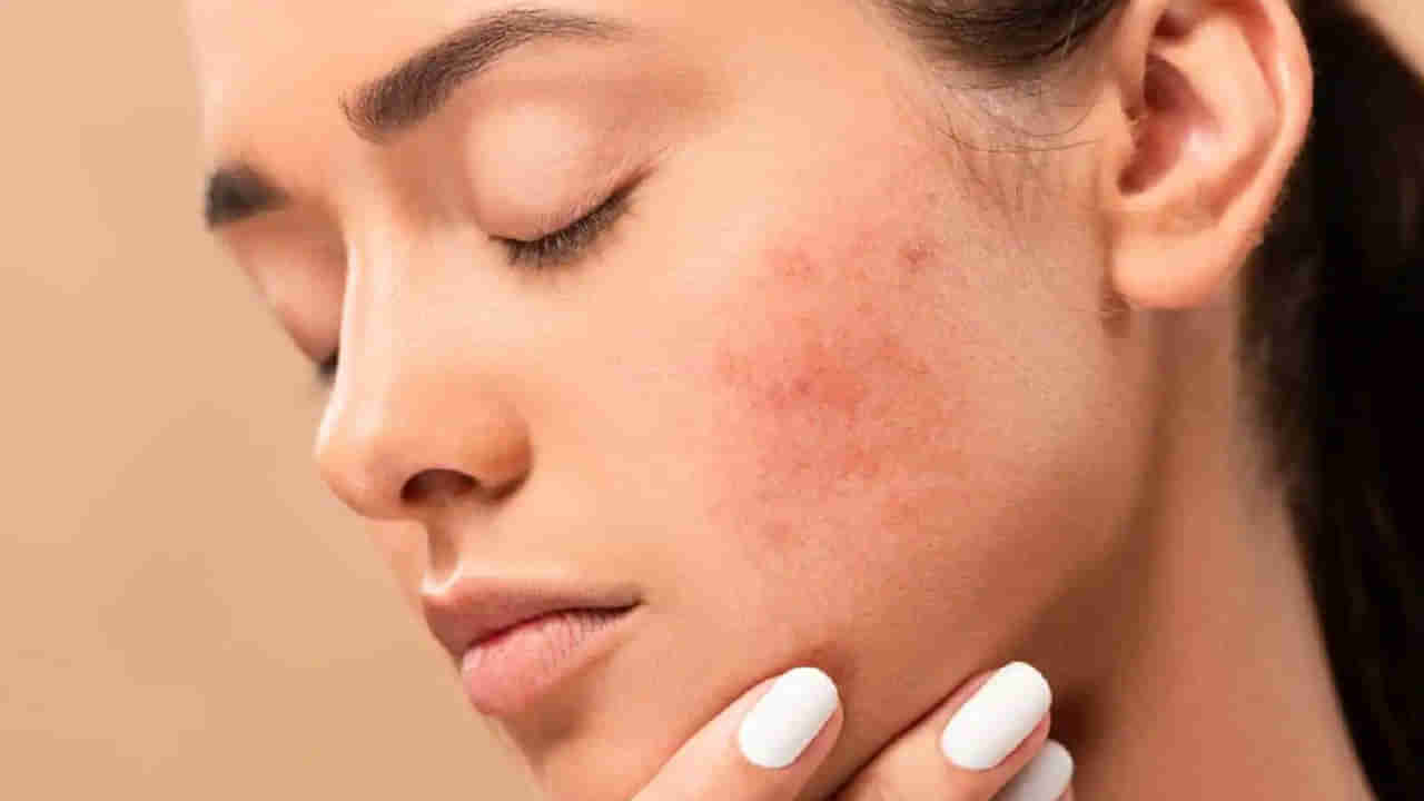 Skin problems: కడుపులో సమస్యలుంటే.. ముఖంపై ఈ లక్షణాలు కనిపిస్తాయ్‌..! నిర్లక్ష్యం చేయకండి..