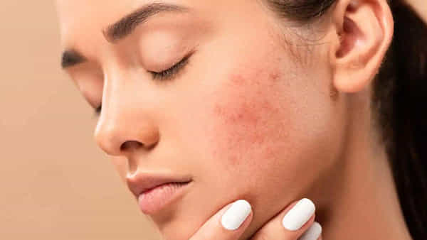 Skin problems: కడుపులో సమస్యలుంటే.. ముఖంపై ఈ లక్షణాలు కనిపిస్తాయ్..! నిర్లక్ష్యం చేయకండి..