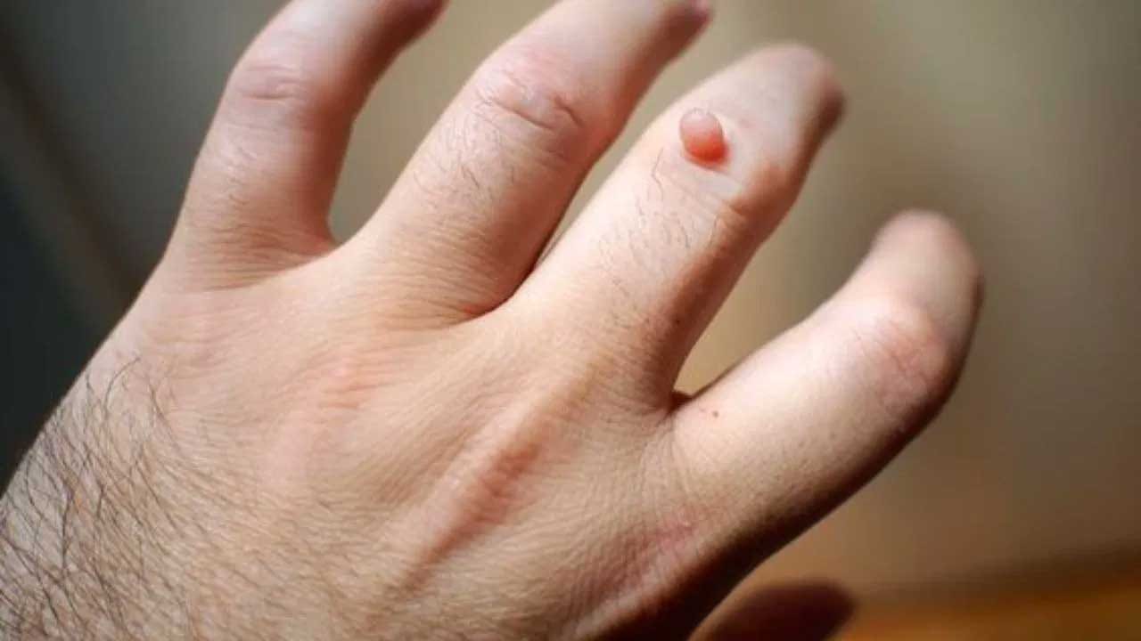 చాలా మందికి శరీరమంతా వివిధ చోట్ల పులిపిరిలు వస్తుంటాయి. ఇవి చూడటానికి అసహ్యంగా ఉండటంతో వీటిని దాచే ప్రయత్నం చేస్తుంటారు. కానీ ఏం చేసిన సమస్య తీరక బాధపడిపోతుంటారు. ఈ పులిపిరి సమస్యకు శాశ్వత పరిష్కారం దొరక్క ఆసుపత్రుల చుట్టూ తిరుగుతూ ఉంటారు. 