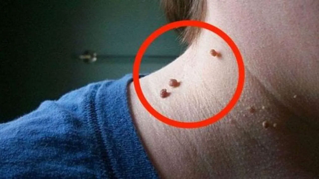 పులిపిరిలను తొలగించడానికి కొంతమంది లేజర్ చికిత్స తీసుకుంటారు. కానీ ఇది అత్యంత ఖర్చుతో కూడుకున్న ప్రక్రియ. అంతేకాకుండా ఈ చికిత్స తర్వాత చర్మంపై దాని ప్రభావాలపై భిన్నాభిప్రాయాలు ఉన్నాయి.అలాకాకుండా పులిపిరిలను సహజంగా వదిలించుకోగలిగే మార్గాలు కూడా ఉన్నాయంటున్నారు నిపుణులు. 