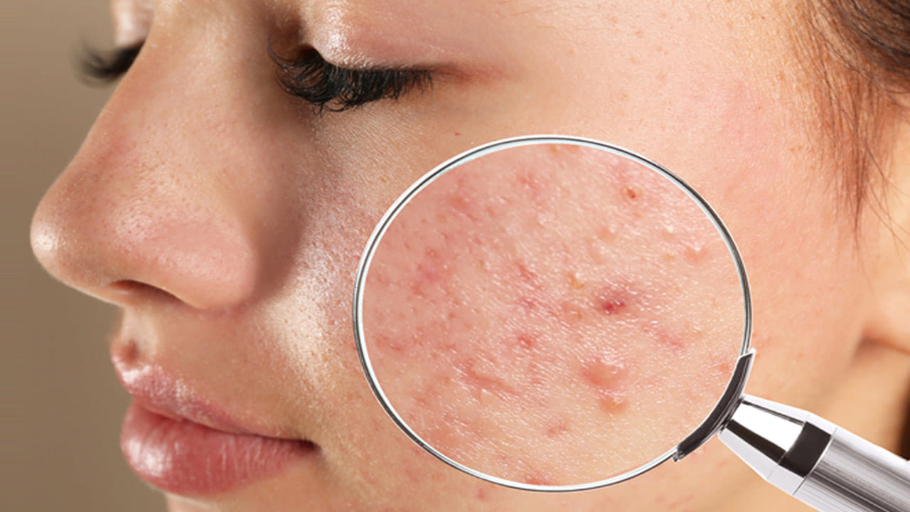 చలికాలంలో చర్మం గరుకుగా, బిగుతుగా ఉంటుంది, కాబట్టి ముఖంపై టోనర్‌ని క్రమం తప్పకుండా రాసుకోవాలి. హార్మోన్ల అసమతుల్యత వల్ల మొటిమలు కూడా పెరగవచ్చు. జిడ్డు చర్మం ఉన్నవారికి ఈ సమస్య మరింత ఎక్కువగా ఉంటుంది. 