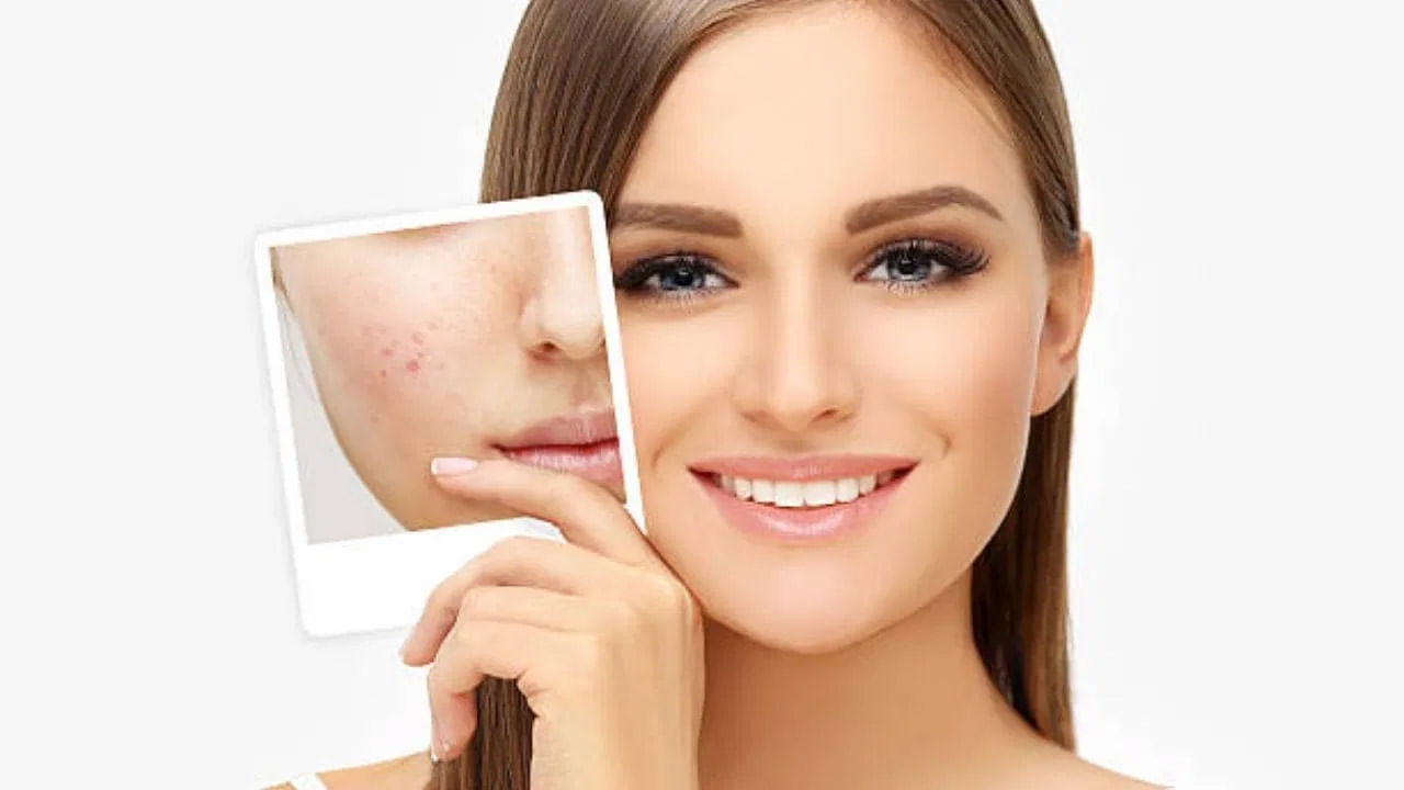 మొటిమలు, దద్దుర్లు వంటి పలురకాల సమస్యలన్నింటి నుంచి విముక్తి పొందడానికి సెలగ పిండి ఫేస్ ప్యాక్ ప్రభావవంతంగా పనిచేస్తుంది. శనగ పిండిలో జింక్ ఉంటుంది. ఇది మొటిమలతో పోరాడటానికి సహాయపడుతుంది. అంతే కాకుండా శెనగపిండిని సరైన పద్ధతిలో ఫేస్ ప్యాక్ ఉపయోగిస్తే, మొటిమల మచ్చలను కూడా తొలగిస్తుంది. చర్మాన్ని ప్రకాశవంతంగా మెరిపిస్తుంది