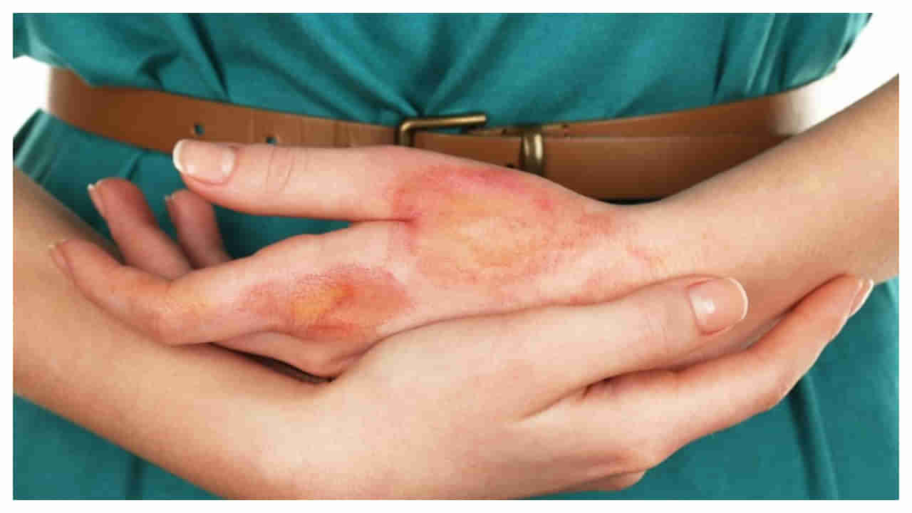 Home Remedies for Burn Injuries: కాలిన గాయాలు త్వరగా తగ్గాలా.. వీటిని ఖచ్చితంగా చేస్తే మాయం అవుతాయ్!