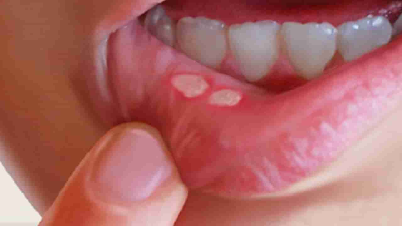 Mouth Ulcers: చలి కాలంలో నోటి పూతతో ఇబ్బంది పడుతున్నారా.. ఈ చిట్కాలతో తొందరగా తగ్గుతుంది!